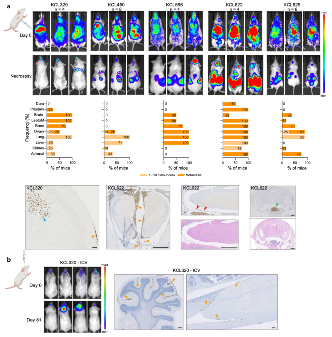 Nature子刊：患者來源的類器官，為乳腺癌腦轉移帶來新見解